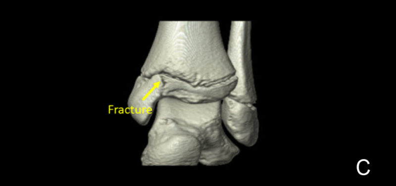 Using CT for Ankle Injuries in Children-C