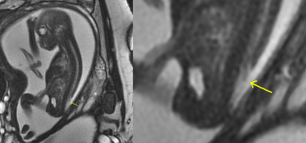 Fetal MRI Research in Chiari II Malformation
