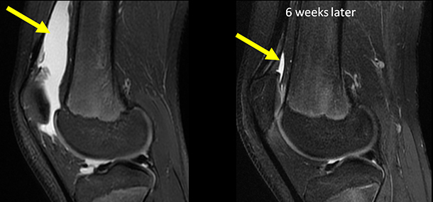 Treating Children with Juvenile Idiopathic Arthritis - Cincinnati ...