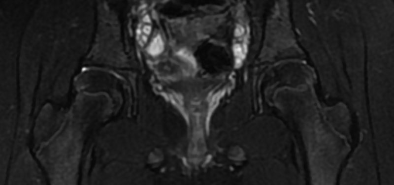 MRI and Its Important Role in Determining Problems with the Pelvis