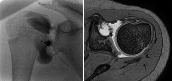 Arthrogram for MRI or CT - Cincinnati Children's Blog