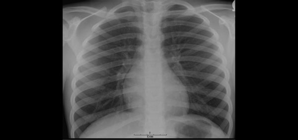 What Can You Tell From A Chest X Ray