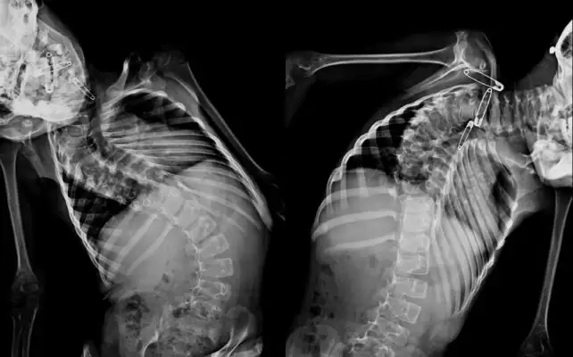 Mission trip to India helps children with severe scoliosis