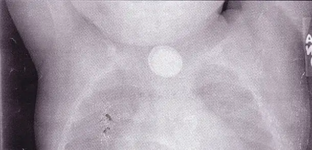 Parents: Beware of Button Batteries During the Holidays