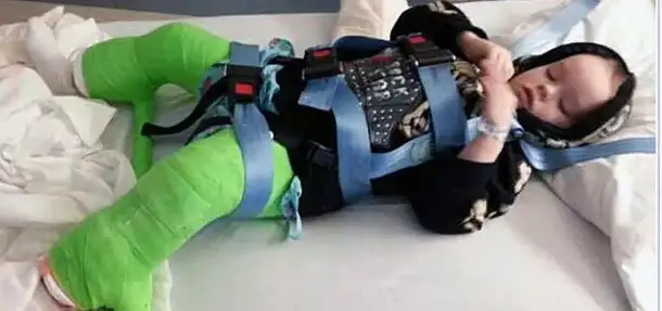 My Son’s Experience with Coxa Vara and a Full-Body Cast