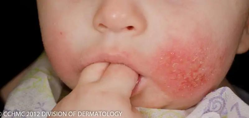 Eczema Management for Kids