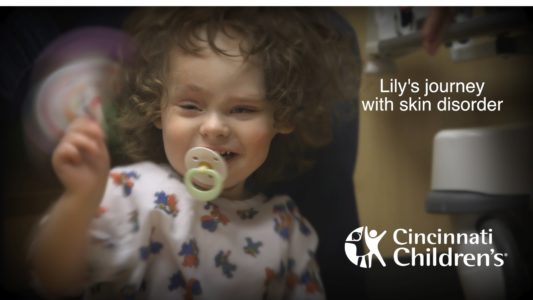 Lily’s Journey with Linear Nevus Sebaceous Syndrome
