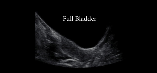 Ultrasounds and Bladders: What’s the Connection?