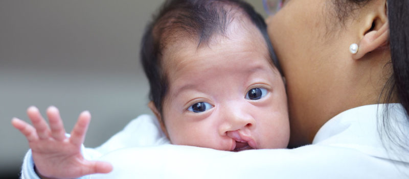 Preparing for a Baby with a Cleft Lip/Palate