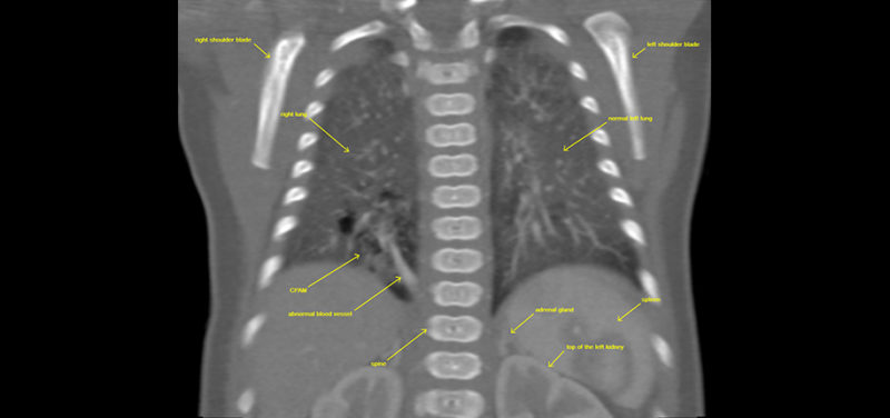 ct-coronal-image-right-lower-lobe-cpam-with-abnormal-blood-vessel