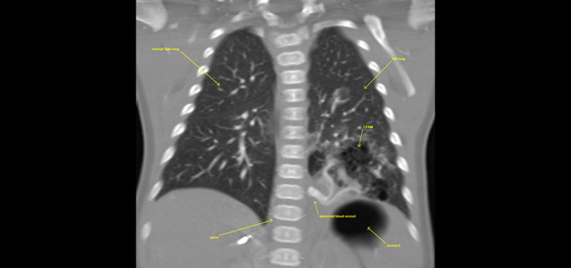 cta-coronal-image-left-lower-lobe-cpam-with-abnormal-vessel