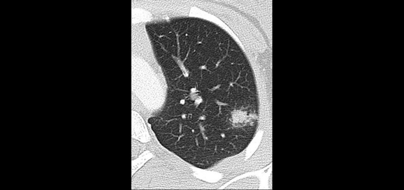 ct-lung-2