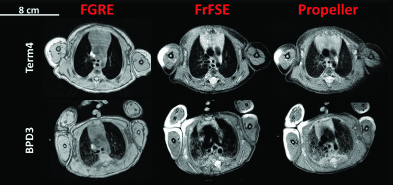MRI Research of Bronchopulmonary Dysplasia in the NICU