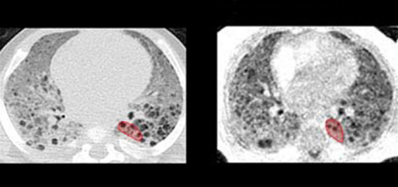 How UTE MRI Images Lung Disease in Infants