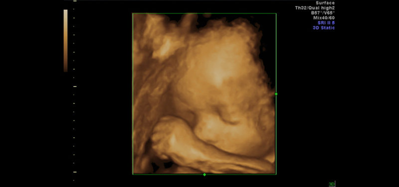 Fetal Imaging Using 3D Ultrasound