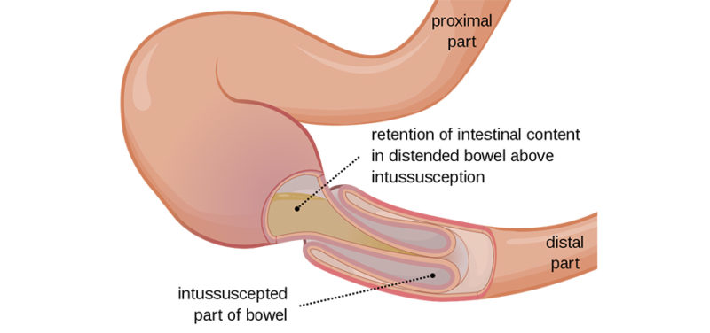 What Is Intussusception Cincinnati Children s Blog