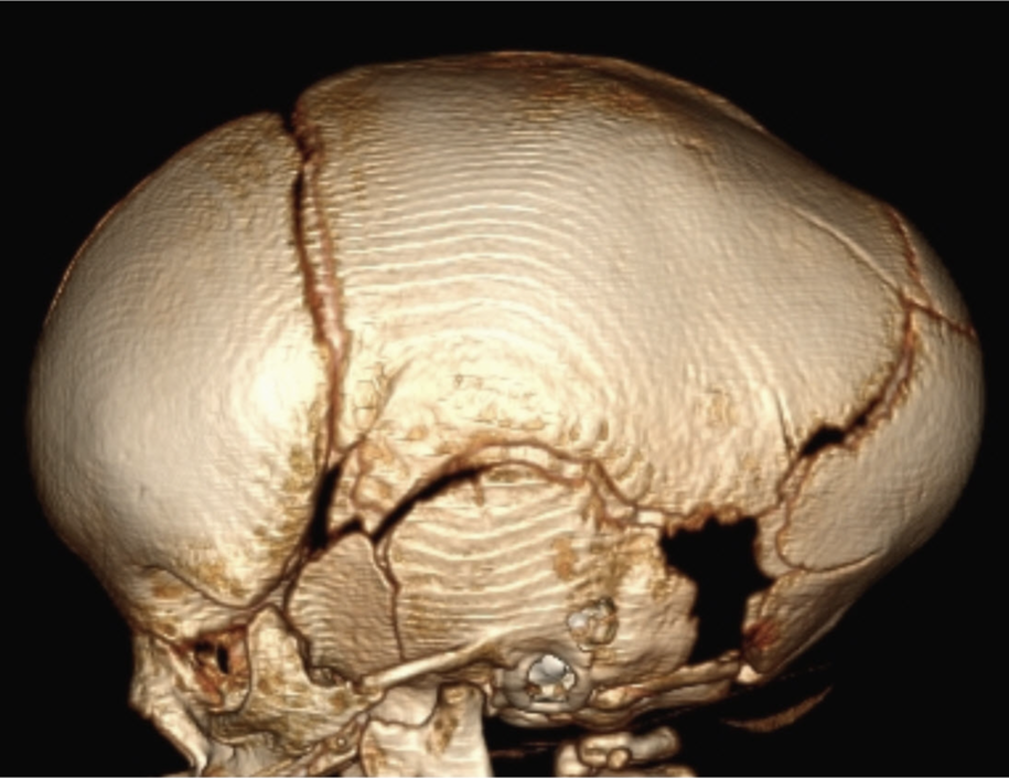 Craniosynostosis: Imaging the Misshapen Head