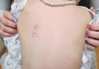 allergy testing.numbering or lettering.smaller