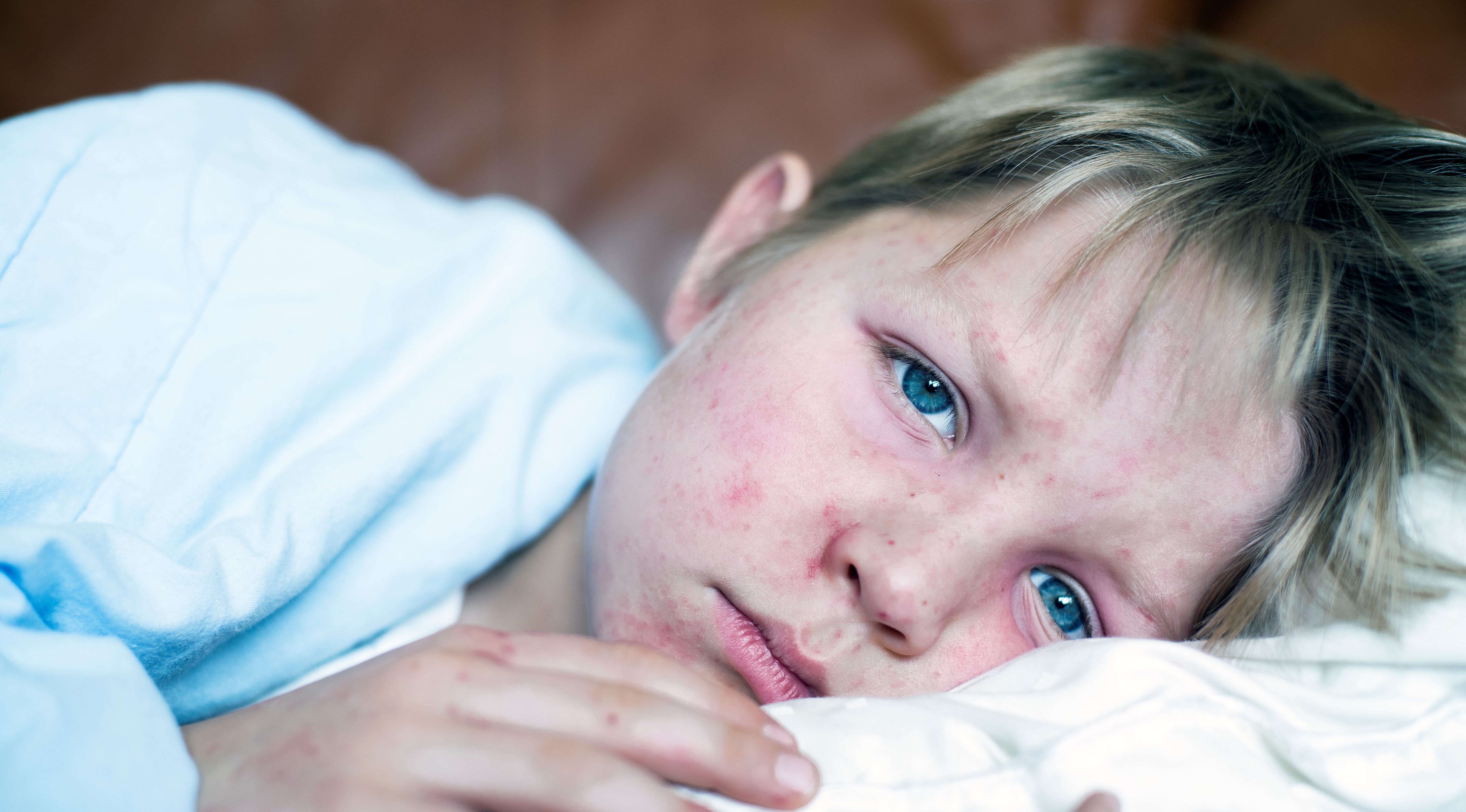 Measles Is Making a Comeback: How to Protect Your Family