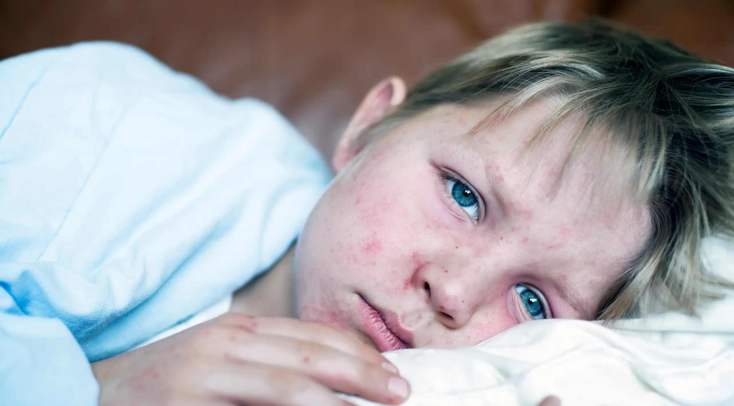 Measles Is Making a Comeback: How to Protect Your Family