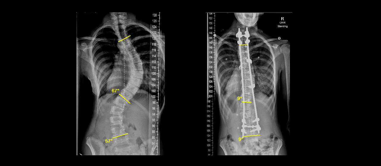 My Journey with an “S” Curve and Adolescent Idiopathic Scoliosis