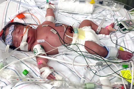 Alana was born with a complex version of tetralogy of Fallot