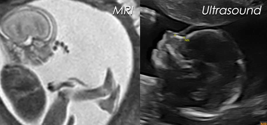 Prenatal Imaging: Ultrasound and Magnetic Resonance Imaging